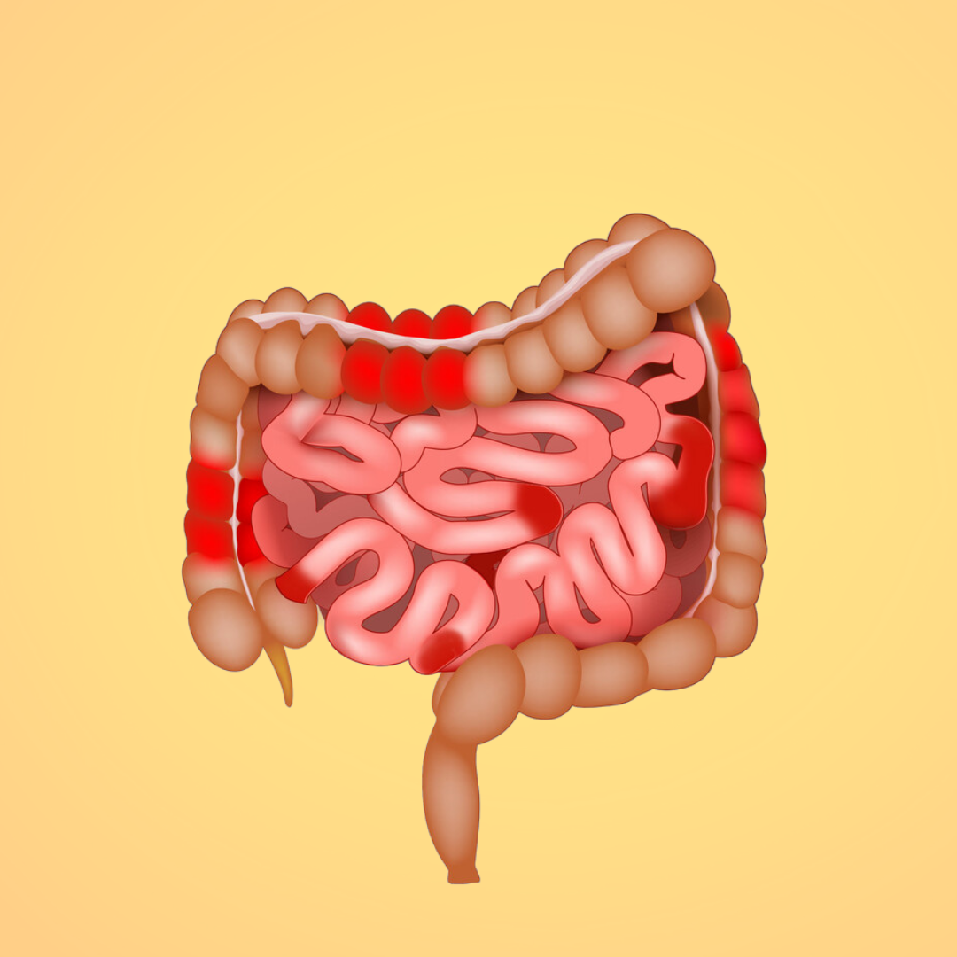 IBS vs. Crohn's disease: Overlaps and Differences