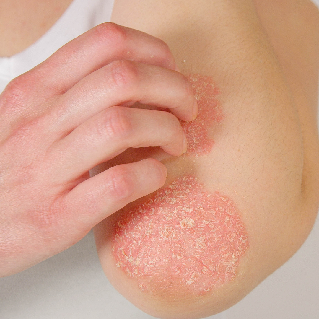 How Your Microbiome Affects Psoriasis